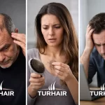 Кой е най-застрашен от оплешивяване – Turhair