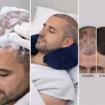 възстановяване след трансплантация на коса сън с повдигната глава възглавница