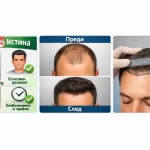 митове за присаждане на коса срещу истина реални резултати трансплантация