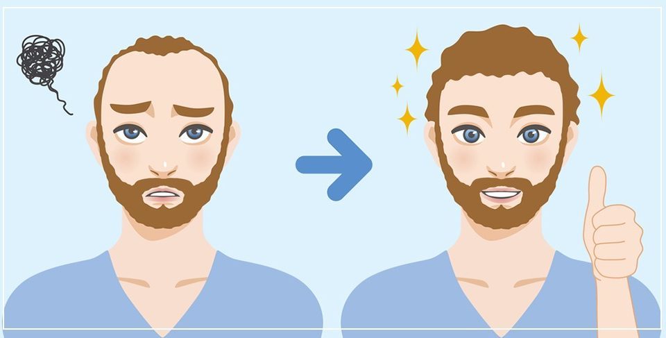 Андрогенна алопеция и как присаждане на коса