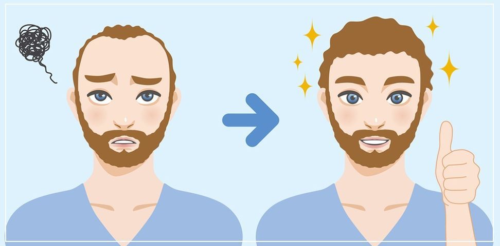 Андрогенна алопеция и как присаждане на коса