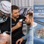 колко графта ми трябват за присаждане на коса