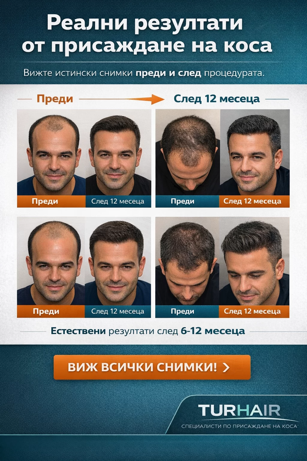 реални резултати присаждане на коса преди и след 12 месеца Turhair естествен резултат