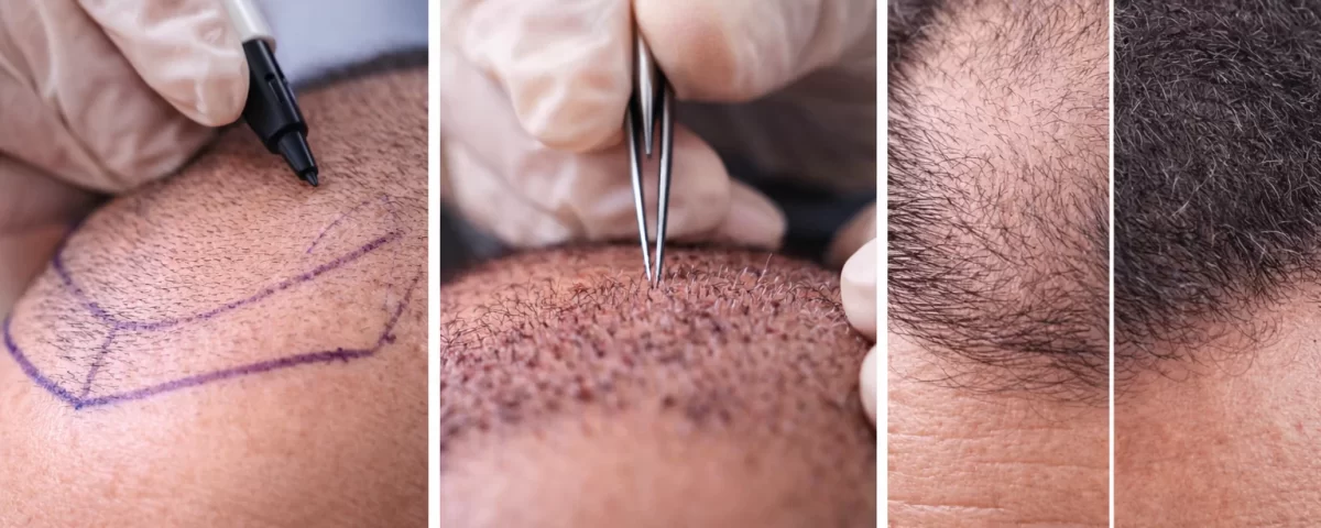 Процес на присаждане на коса – планиране на линия, имплантиране на графтове и естествен резултат