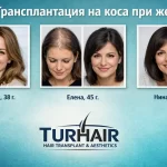 Трансплантация на коса при жени преди и след резултати TURHAIR