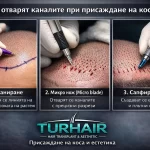Как се отварят каналите при присаждане на коса – планиране, микро нож и сапфирен връх | Turhair