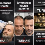 Безболезнено присаждане на коса с лекарско участие – Turhair резултати преди и след естествена линия на косата