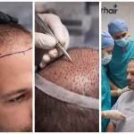 Присаждане на коса – дизайн на линия, отваряне на канали и медицински контрол по време на процедурата