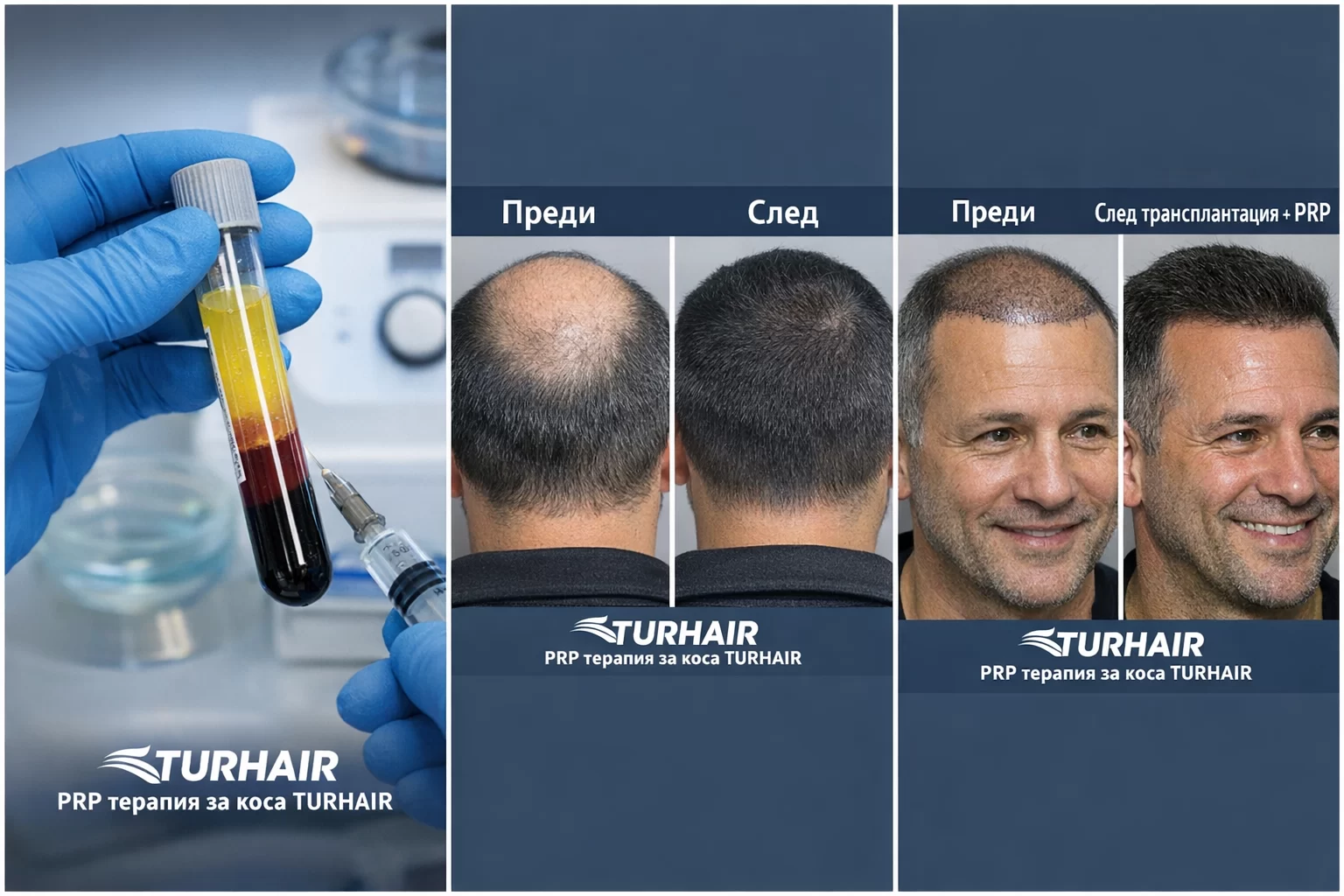 PRP терапия за коса TURHAIR преди и след резултати трансплантация коса