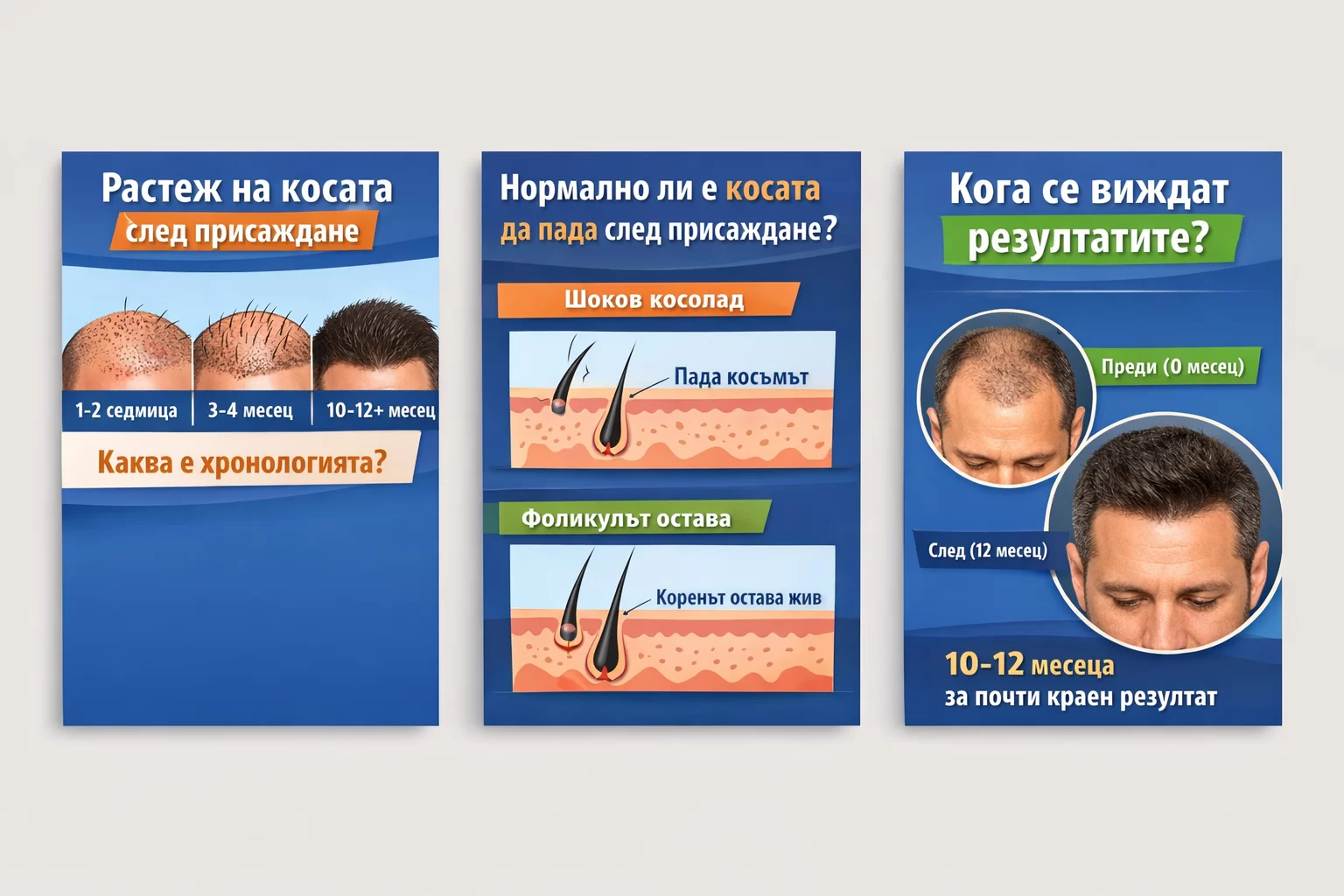 Растеж на косата след присаждане – етапи 1 до 12 месец, шоков косопад и крайни резултати