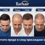 Резултати преди и след присаждане на коса Turhair – естествени резултати с лекар
