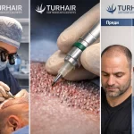 DHI трансплантация на коса в Turhair с Choi pen директно имплантиране и естествени резултати преди и след