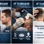 резултати от присаждане на коса TURHAIR преди и след, донорска зона и фактори като генетика и грижа