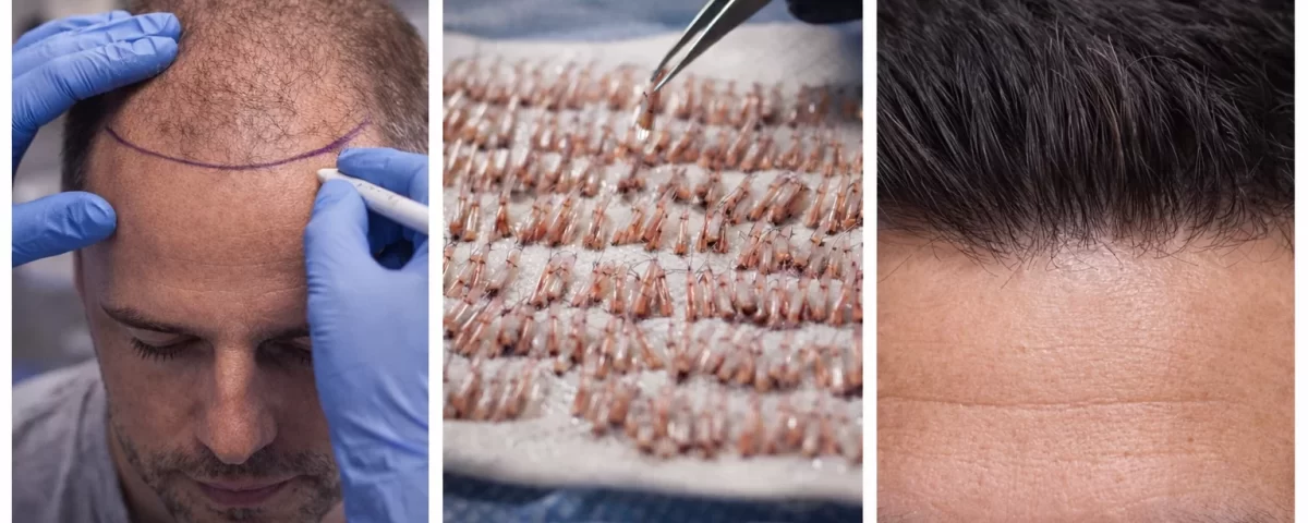 Turhair разлика – лекарско участие, ограничен брой пациенти и естествен резултат при присаждане на коса