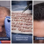 Turhair разлика – лекарско участие, ограничен брой пациенти и естествен резултат при присаждане на коса