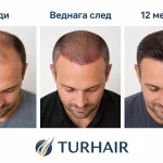 TURHAIR трансплантация на коса преди веднага след и 12 месеца по-късно