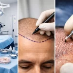 Процес на присаждане на коса в Турция – клиника, планиране на линия и имплантиране на графтове