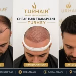 трансплантацията на коса е по-евтина в Турция