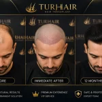 Резултат преди и след трансплантация на коса в TURHAIR Истанбул с естествена линия на косата след 12 месеца
