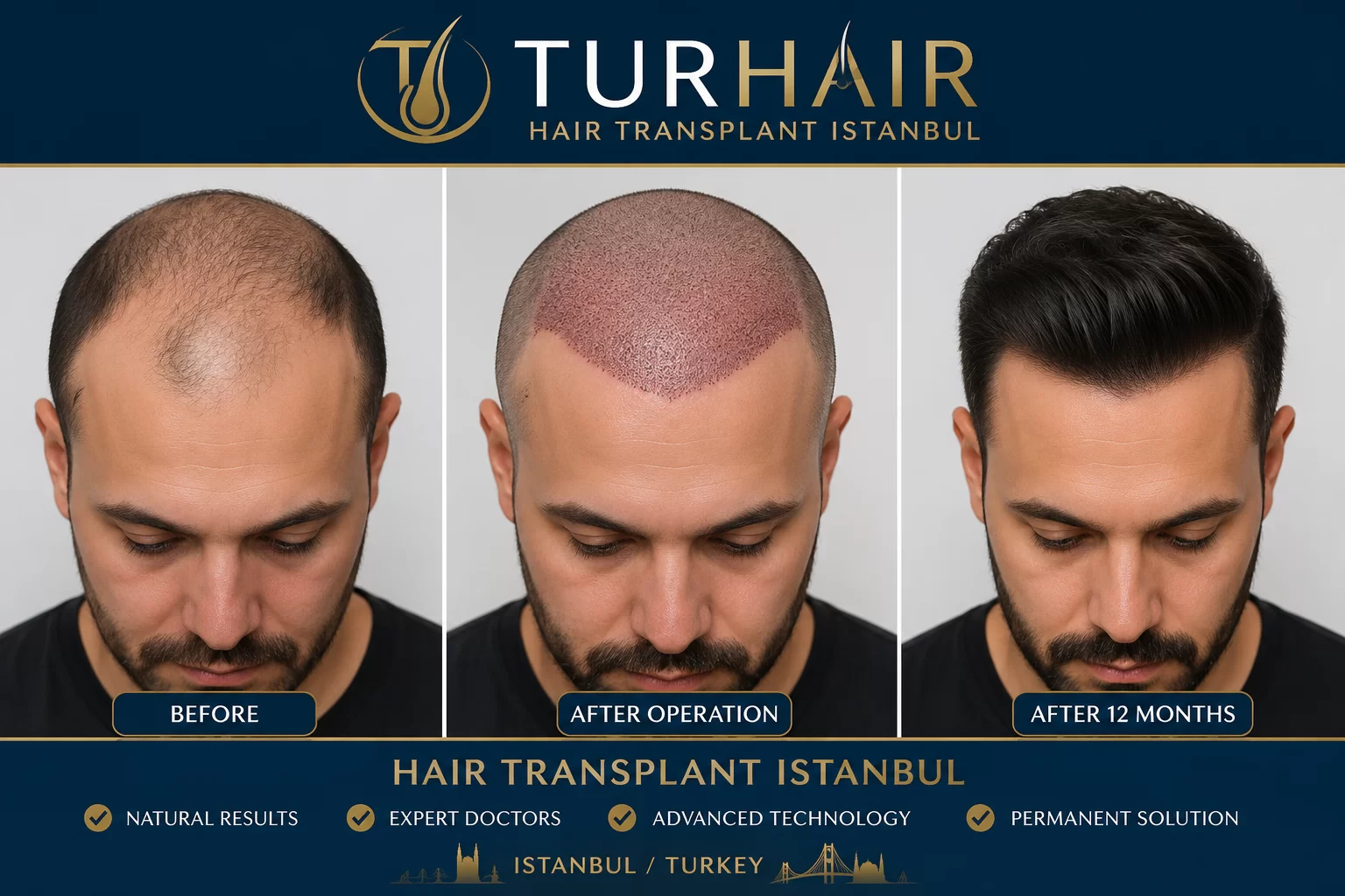 Трансплантация на коса в Истанбул преди и след резултати TURHAIR