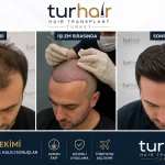 FUE трансплантация на коса в Турция в клиника TURHAIR Истанбул – преди, по време и след процедурата с естествени резултати.