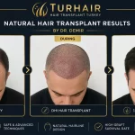 Процент на Успех при Трансплантация на Коса