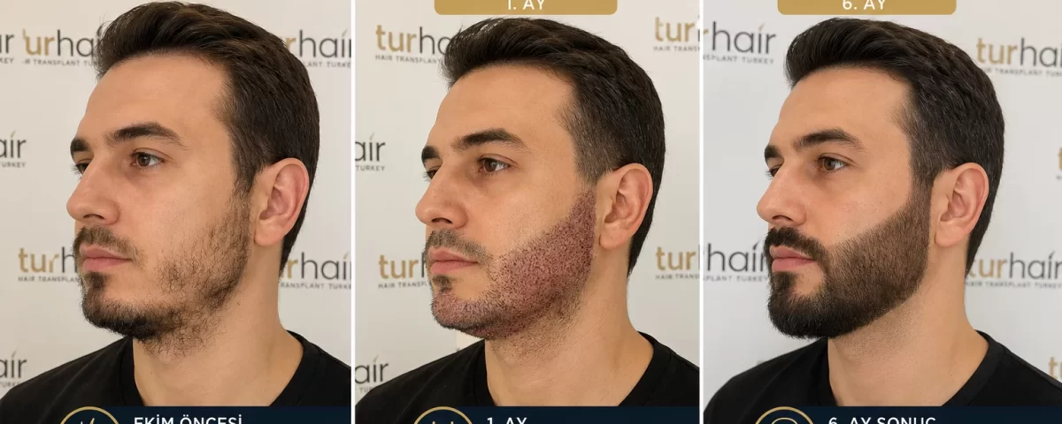 Трансплантация на брада в Турция преди и след процедурата в TurHair – естествен и гъст резултат след 6 месеца.
