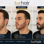 Трансплантация на брада в Турция преди и след процедурата в TurHair – естествен и гъст резултат след 6 месеца.
