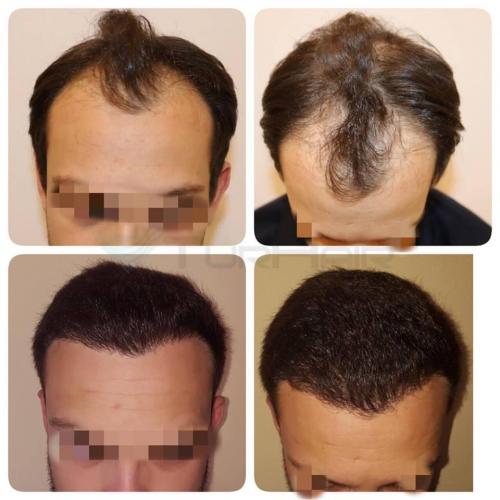 Резултат от присаждане на коса