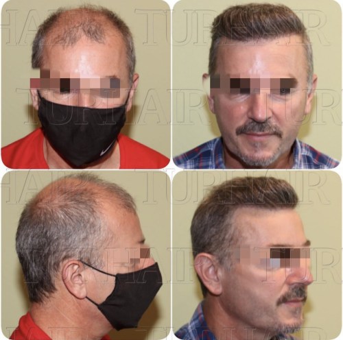 Резултат от присаждане на коса