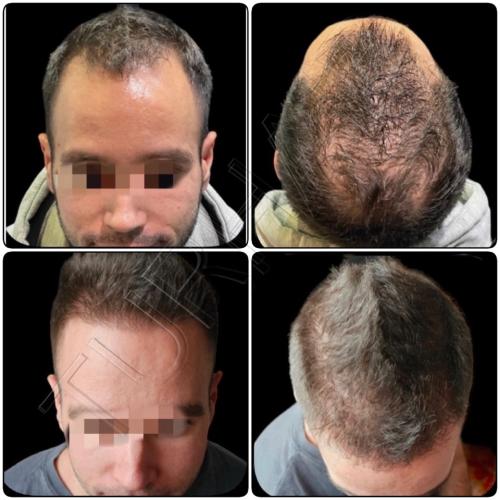 Резултат от присаждане на коса