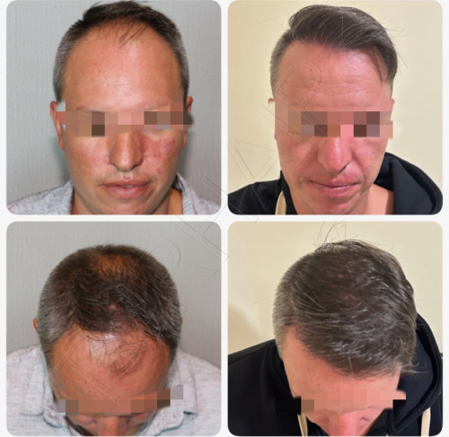 Резултат от присаждане на коса