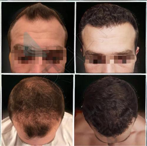 Резултат от присаждане на коса